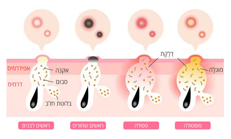 leorex pure לאורקס פיור אקנה